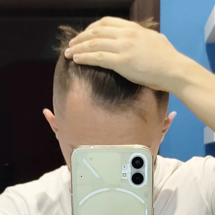 Мъж, 24 — темето в ден 0