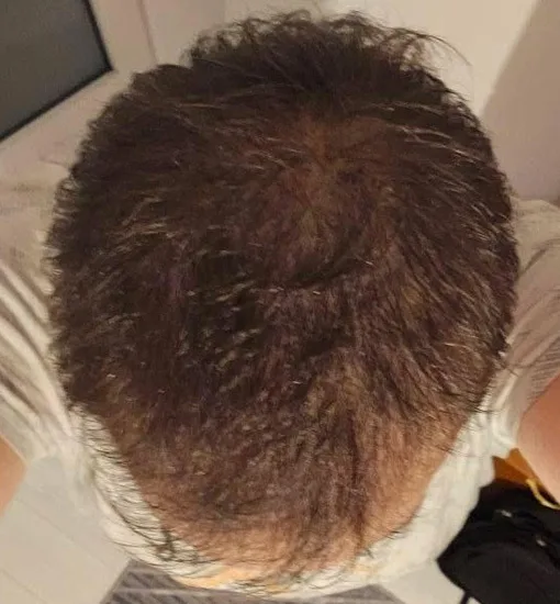 Мъж, 26 — същият ъгъл в ден 90